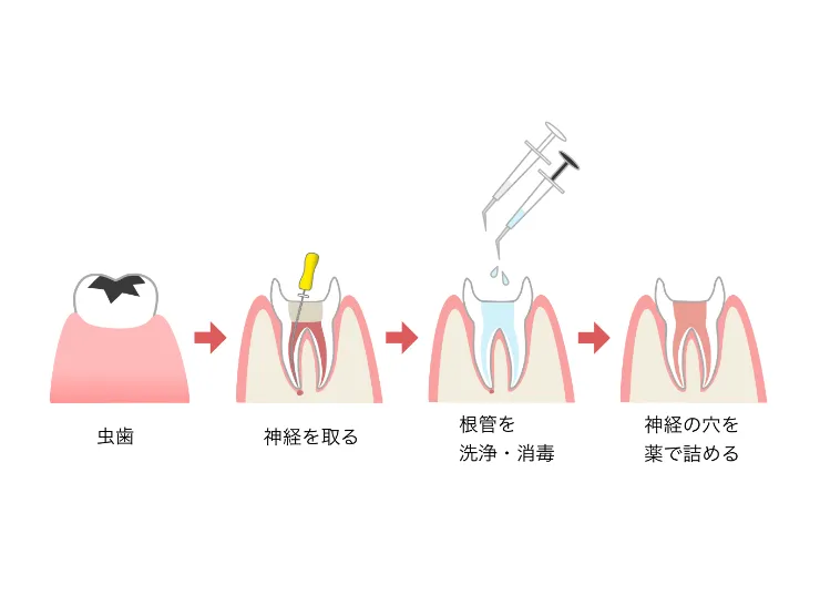 根管治療（歯の神経の治療）
