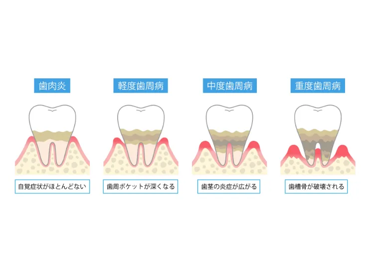 歯周病の進行と治療方法