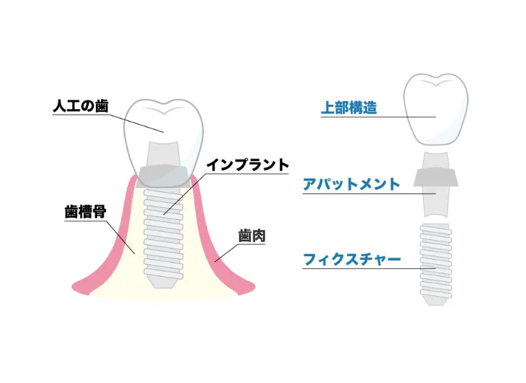 インプラントの仕組み
